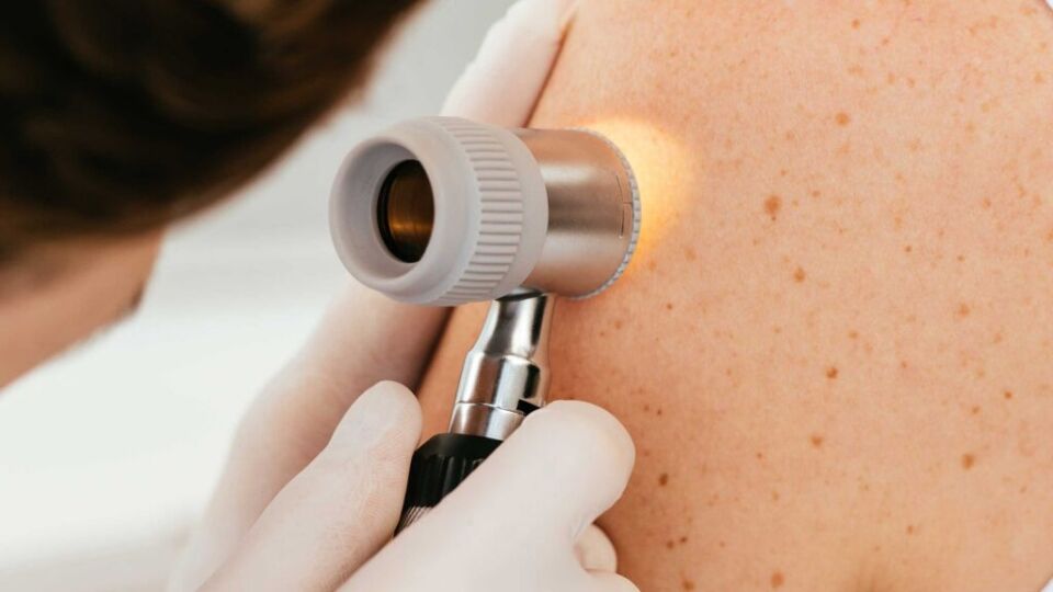 Dermatologist examining skin cancer mole on back - Dermatology Clinics Australia