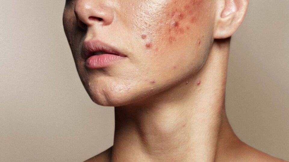 Acne flare-up and enlarged pores before treatment - Dermatology Clinics Australia
