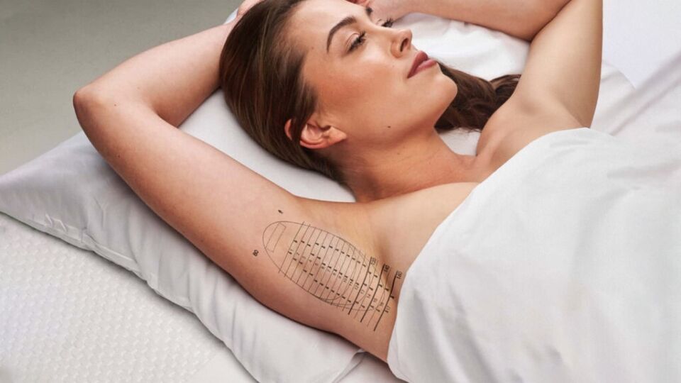 Excessive sweating hyperhidrosis consultation - Dermatology Clinics Australia